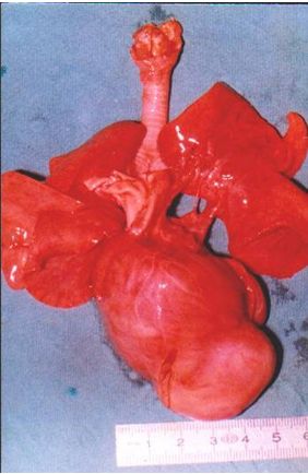 rabdomioma_cardiaco_neonato/autopsia_4 rabdomioma_cardiaco_neonato/autopsia_4
