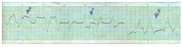 rabdomioma_cardiaco_neonato/ecg_wpw rabdomioma_cardiaco_neonato/ecg_wpw