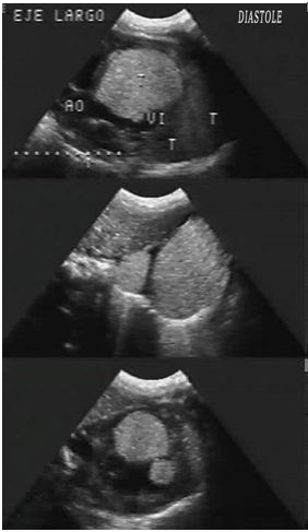 rabdomioma_cardiaco_neonato/eco_diastole rabdomioma_cardiaco_neonato/eco_diastole