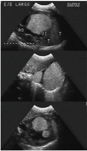 rabdomioma_cardiaco_neonato/eco_diastole