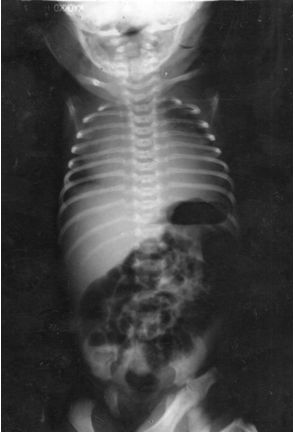 rabdomioma_cardiaco_neonato/rx_torax rabdomioma_cardiaco_neonato/rx_torax