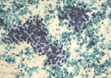 sindrome_cushing_carcinoma/biopsia_masa_intrahepatica sindrome_cushing_carcinoma/biopsia_masa_intrahepatica