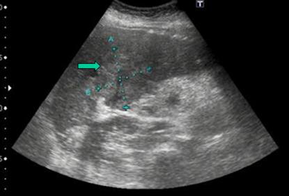 sindrome_cushing_carcinoma/ecografia_masa_intrahepatica sindrome_cushing_carcinoma/ecografia_masa_intrahepatica