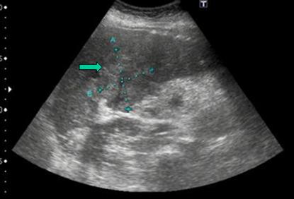 sindrome_cushing_carcinoma/ecografia_masa_intrahepatica