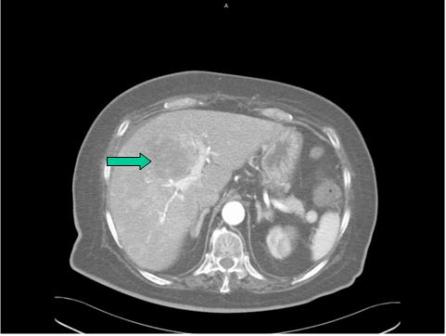 sindrome_cushing_carcinoma/resonancia_masa_intrahepatica