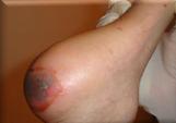 ulceras_presion_enfermeria_UPP/ulcera ulceras_presion_enfermeria_UPP/ulcera