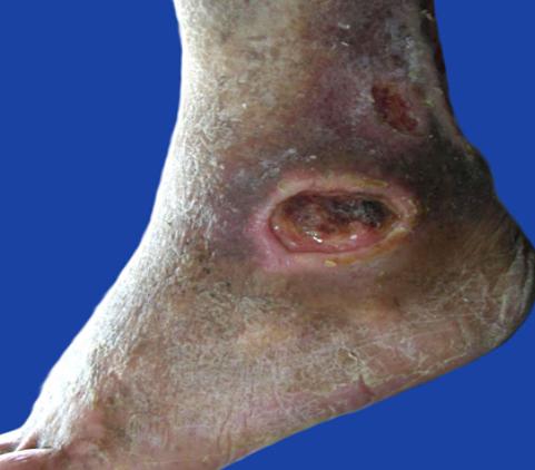 ulceras_presion_enfermeria_UPP/ulcera_tobillo ulceras_presion_enfermeria_UPP/ulcera_tobillo