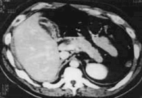 manejo_ascaridiasis_pediatria/TAC_ascaris_vesicula_biliar_doble_riel manejo_ascaridiasis_pediatria/TAC_ascaris_vesicula_biliar_doble_riel