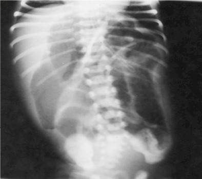 manejo_ascaridiasis_pediatria/asas_intestinales_distendidas_ascaris