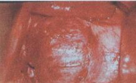 manejo_ascaridiasis_pediatria/coledoco_dilatado_dilatacion_ascaris_lumbricoides manejo_ascaridiasis_pediatria/coledoco_dilatado_dilatacion_ascaris_lumbricoides