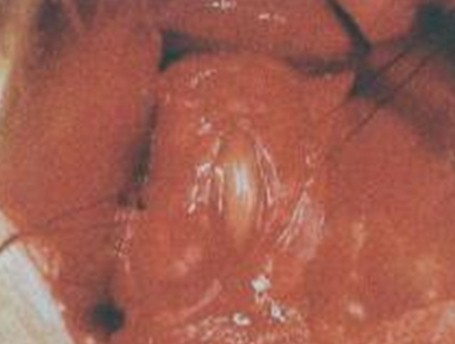 manejo_ascaridiasis_pediatria/coledocotomia_ascaris_lumbricoides manejo_ascaridiasis_pediatria/coledocotomia_ascaris_lumbricoides