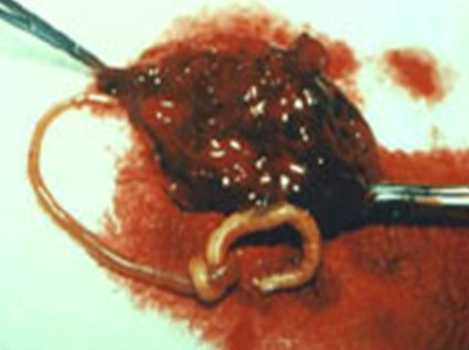manejo_ascaridiasis_pediatria/extirpacion_vesicula_biliar_ascaris_lumbricoide manejo_ascaridiasis_pediatria/extirpacion_vesicula_biliar_ascaris_lumbricoide