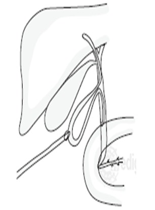 manejo_ascaridiasis_pediatria/extraccion_laparoscopica_ascaris_coledoco manejo_ascaridiasis_pediatria/extraccion_laparoscopica_ascaris_coledoco