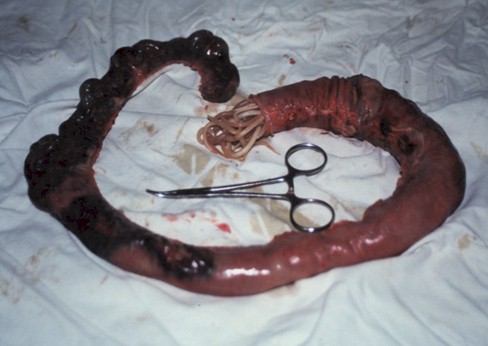 manejo_ascaridiasis_pediatria/intestino_delgado_resecado_ascaris_lumbricoides