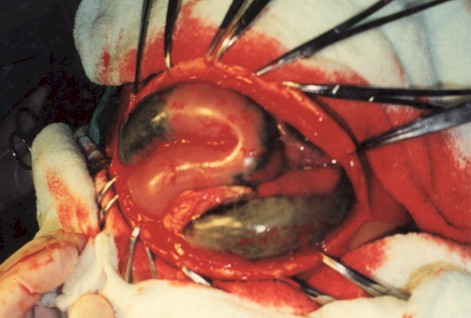 manejo_ascaridiasis_pediatria/volvulo_necrosis_hemorragica_gangrena_cirugia