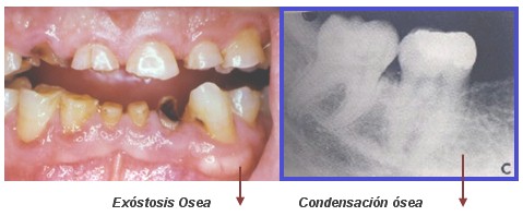 alteraciones_oseas