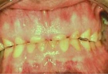 desgastes_dentarios desgastes_dentarios