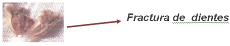 fractura_dientes fractura_dientes
