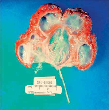 displasia_renal displasia_renal