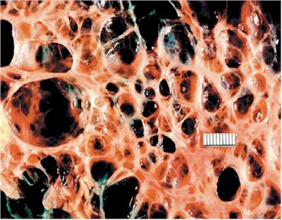 enfermedad_quistica_quistes enfermedad_quistica_quistes