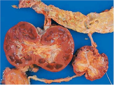 fallo_renal fallo_renal