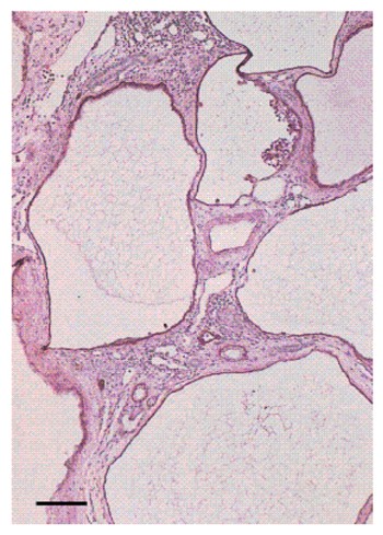 perdida_tejido_renal perdida_tejido_renal