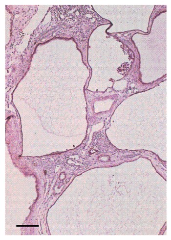 perdida_tejido_renal