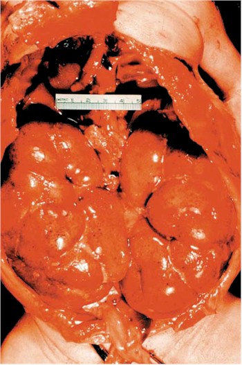 poliquistosis_renal