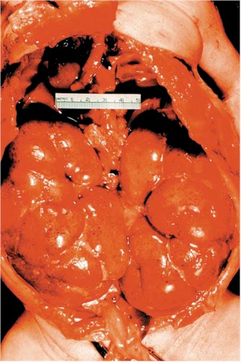 poliquistosis_renal poliquistosis_renal