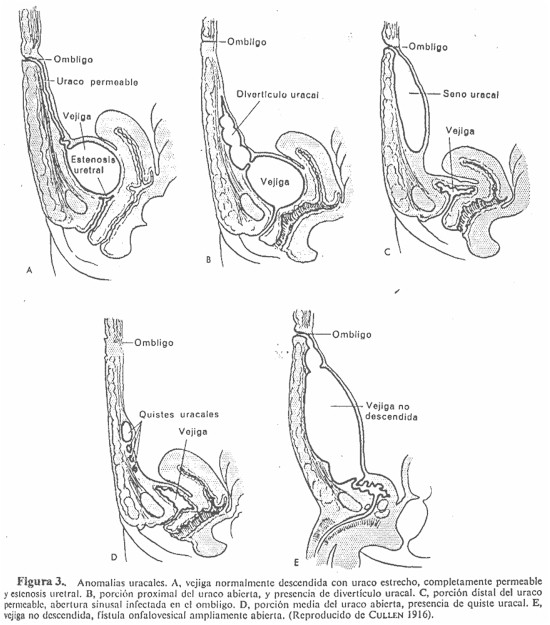 umbilicovesical_anomalias_uracales