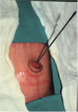 fistula_umbilicovesical_fistula_umbilical