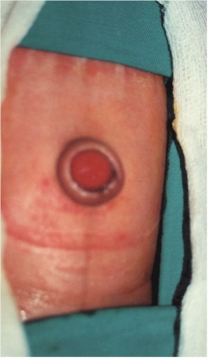 fistula_umbilicovesical_granuloma_umbilical