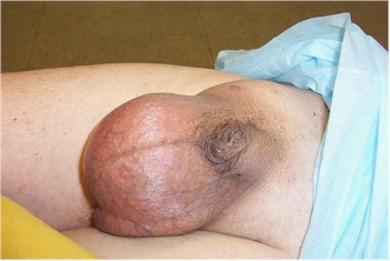 hernia_amyand hernia_amyand