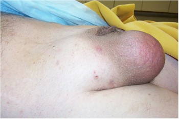 hernia_amyand2 hernia_amyand2