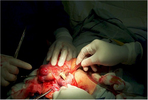 hernia_inguinoescrotal_cirugia2 hernia_inguinoescrotal_cirugia2