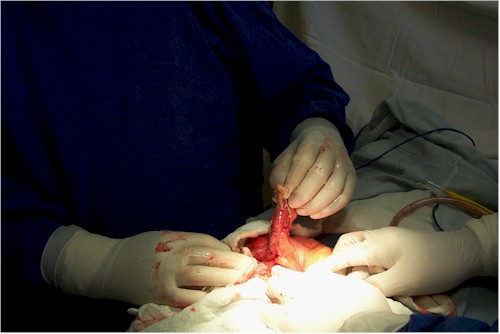 hernia_inguinoescrotal_cirugia3 hernia_inguinoescrotal_cirugia3