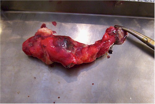 hernia_inguinoescrotal_cirugia4 hernia_inguinoescrotal_cirugia4