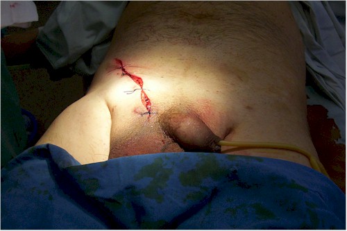 hernia_inguinoescrotal_cirugia5 hernia_inguinoescrotal_cirugia5