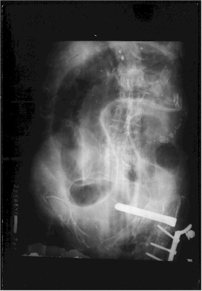 perforacion_sigmoide_rx2 perforacion_sigmoide_rx2