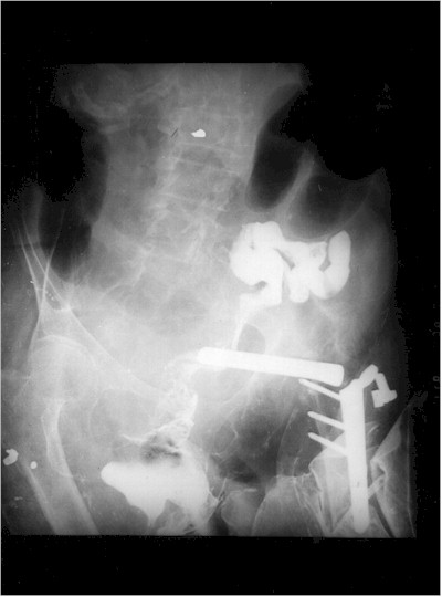 perforacion_sigmoide_rx3 perforacion_sigmoide_rx3