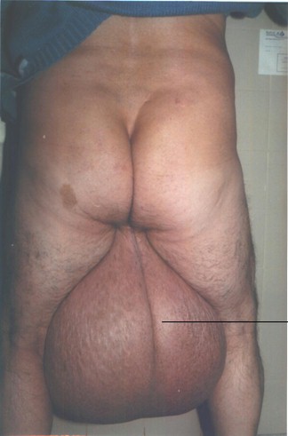 elefantiasis_testicular_escroto_