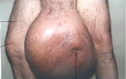 elefantiasis_testicular_escroto_3 elefantiasis_testicular_escroto_3