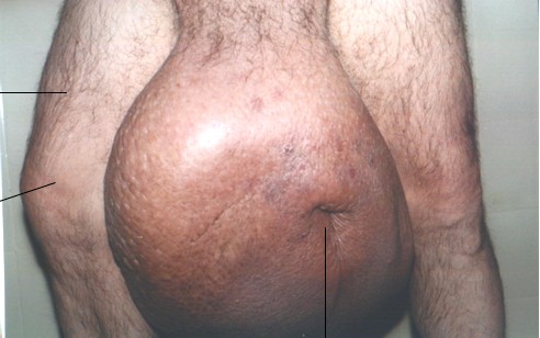 elefantiasis_testicular_escroto_3