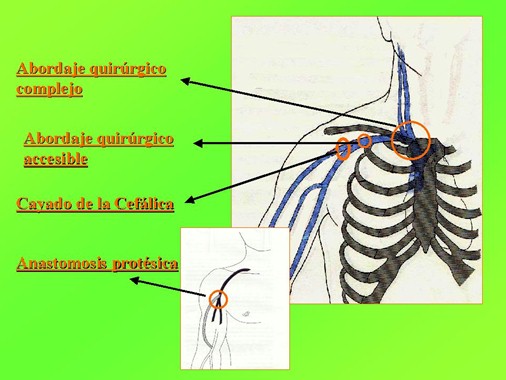 fistulas_arteriovenosas_hemodialisis_1 fistulas_arteriovenosas_hemodialisis_1