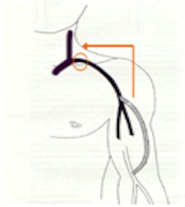 fistulas_arteriovenosas_hemodialisis_11 fistulas_arteriovenosas_hemodialisis_11