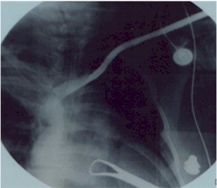 fistulas_arteriovenosas_hemodialisis_13 fistulas_arteriovenosas_hemodialisis_13