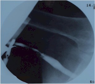 fistulas_arteriovenosas_hemodialisis_14 fistulas_arteriovenosas_hemodialisis_14