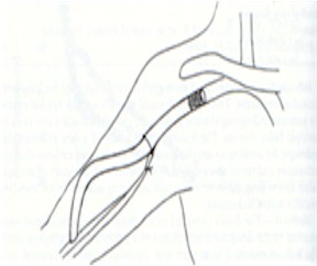 fistulas_arteriovenosas_hemodialisis_15 fistulas_arteriovenosas_hemodialisis_15