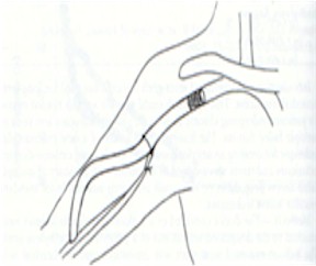 fistulas_arteriovenosas_hemodialisis_15