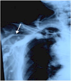 fistulas_arteriovenosas_hemodialisis_2 fistulas_arteriovenosas_hemodialisis_2